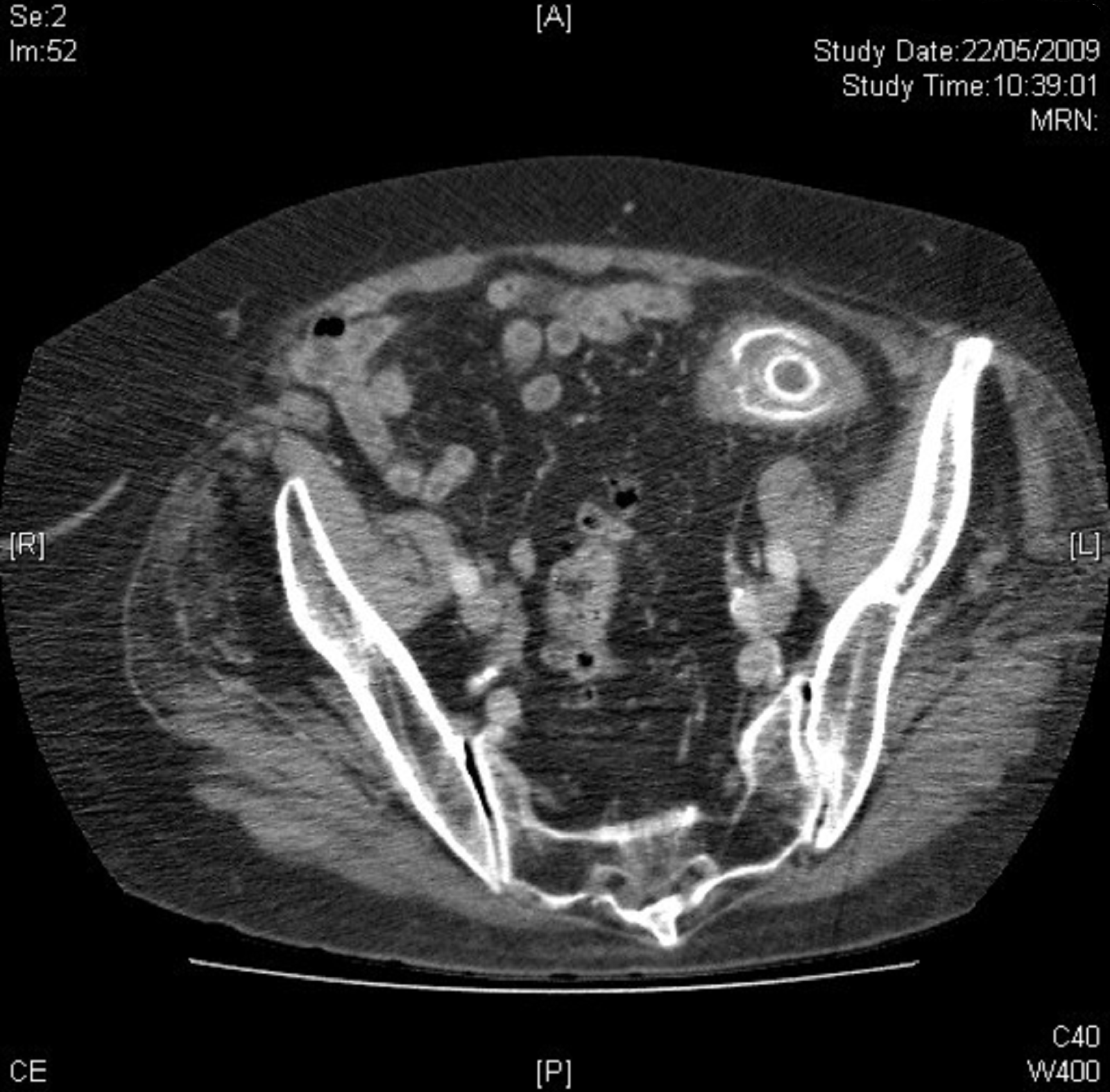 Full Text Endoscopic laser lithotripsy for gallstone large bowel