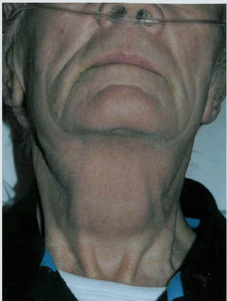 Swelling Submandibular Swelling