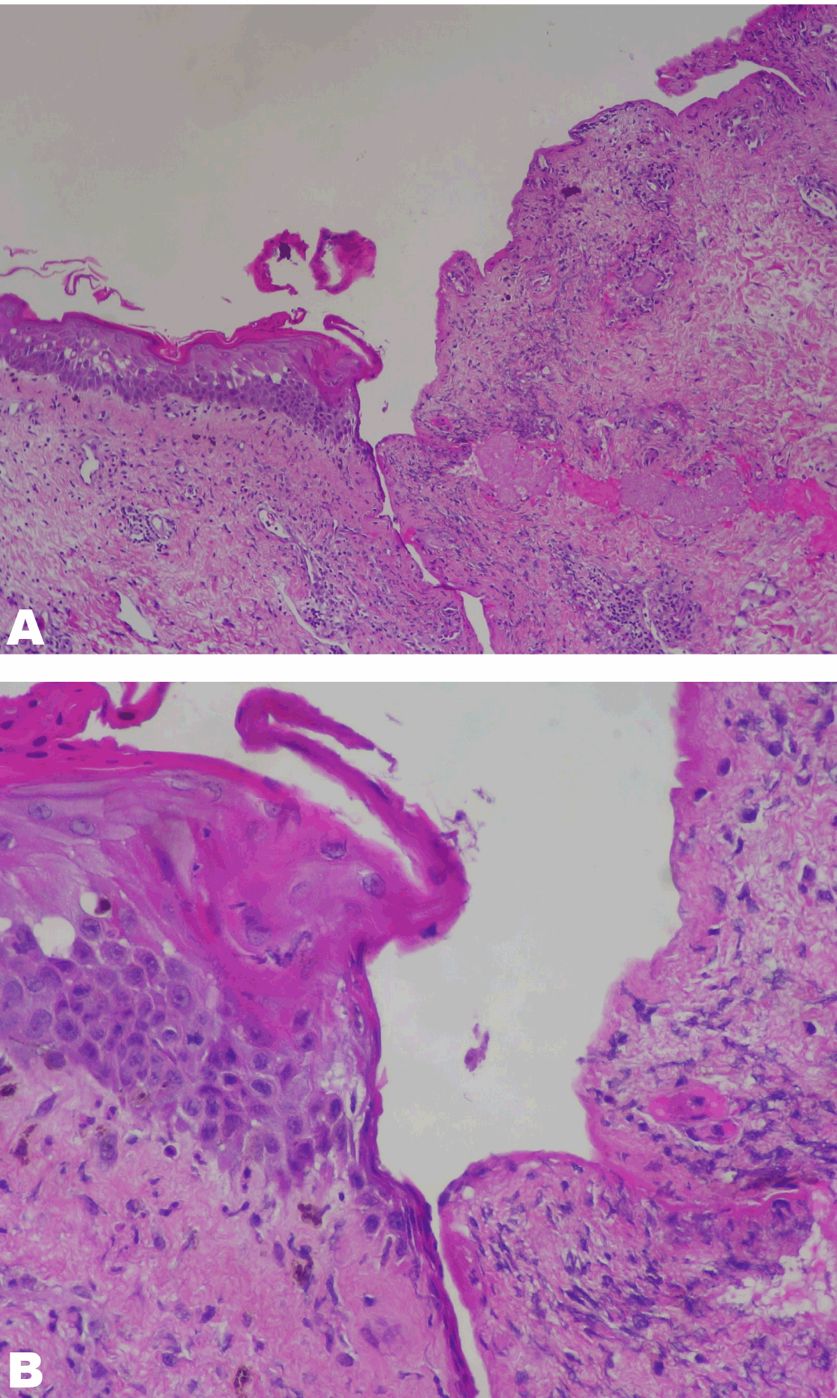 FULL TEXT DRESS syndrome associated with allopurinol International