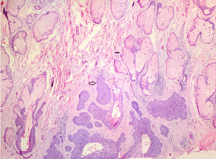 FULL TEXT A case of basal cell carcinoma secondary to nevus sebaceous