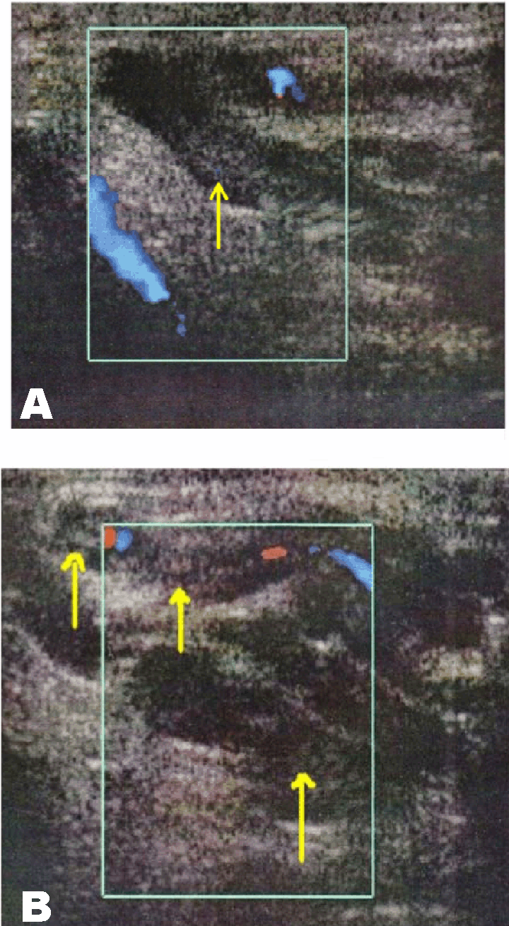FULL TEXT Spontaneous spermatic vein thrombosis as a circumstance of
