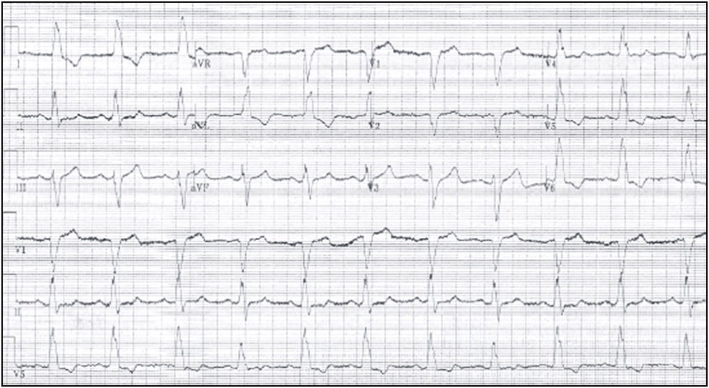Full Text Complete atrioventricular block during central venous catheter placement with pre