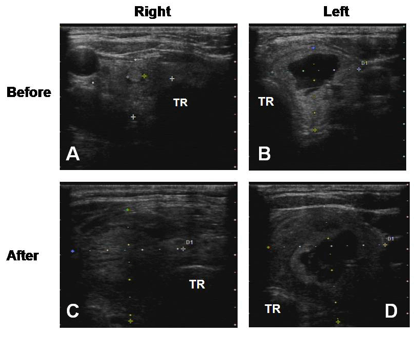 FULL TEXT Acute thyroid swelling after fineneedle aspiration biopsy