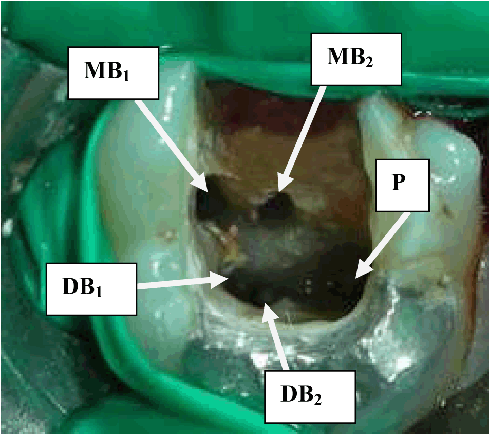 FULL TEXT The root canal treatment in maxillary and mandibular molars