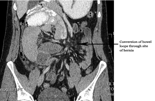 Full Text Paraduodenal Hernia Presenting As Acute Intestinal