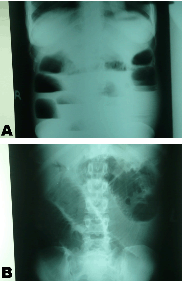 FULL TEXT Solitary ileal bezoar A rare cause of acute ileal