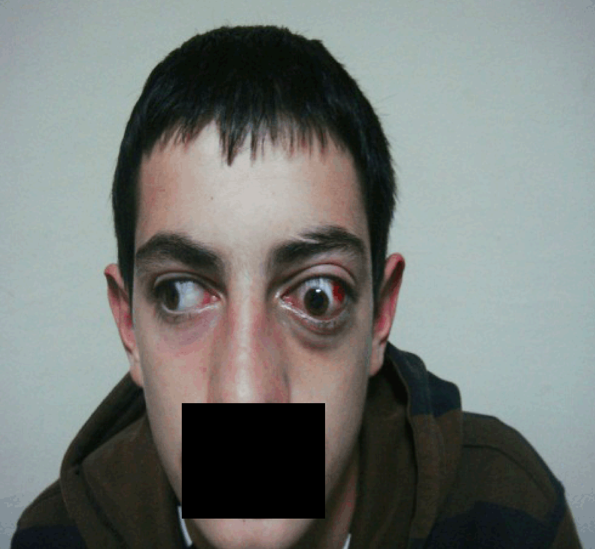 Lymphangioma of the orbit, image size:1175x1084