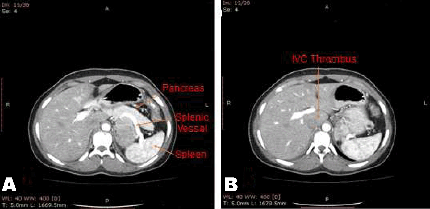 FULL TEXT A rare case of left adrenal cortical carcinoma with