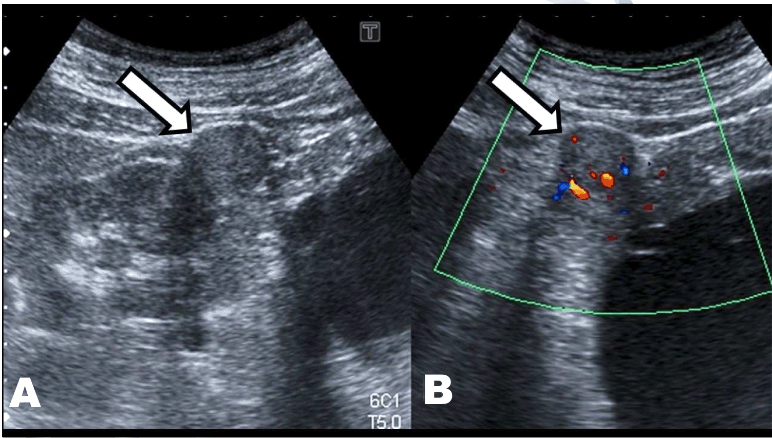 Full Text Renal Carcinoma Complicating Autosomal Dominant Polycystic