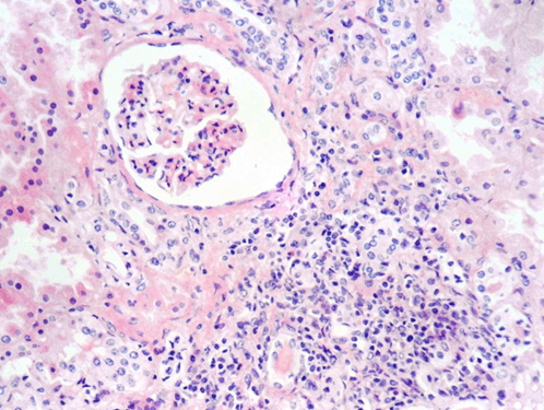 FULL TEXT - Emphysematous pyelonephritis in a non-diabetic patient ...