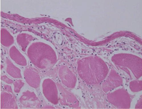 FULL TEXT - Necrotizing fasciitis of lower limb: Is it ischemia or E ...
