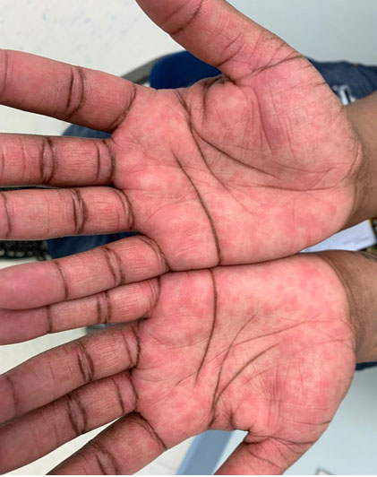 Stevens Johnson Syndrome Hands